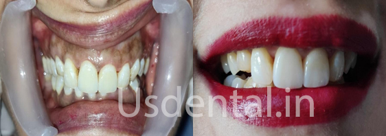 A Permanent Solution Which Lasts Longer Compared to Older Composite Filling - Case of the Month
