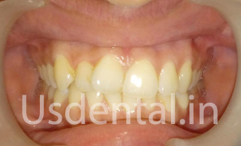 Before and After Misalignment Teeth Alignment – Case of the Month