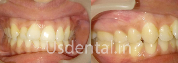 Before and After Misalignment Teeth Alignment – Case of the Month