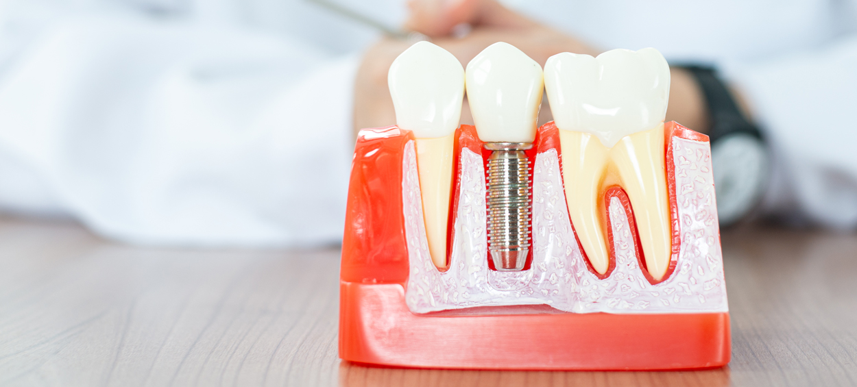 Temporary Eating Habits After Your Dental Implant Treatment