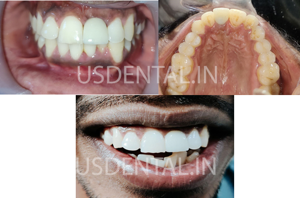 Replacing Missing or Broken Front Teeth - Case of the Month