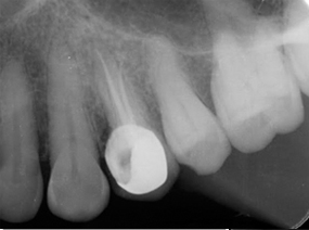 Can Root canal treatment be painless?
