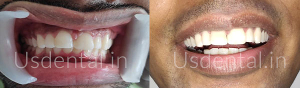 Can Root canal treatment be painless?