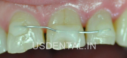 What Happens If You Lose a Tooth in An Accident?