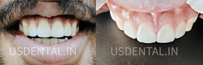 How to fix a chipped tooth?