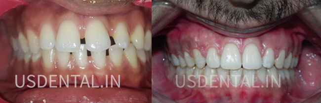 How to fix a chipped tooth?