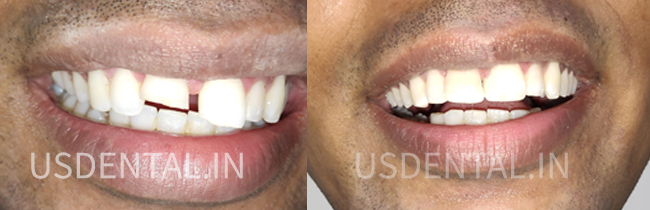 How to fix a chipped tooth?