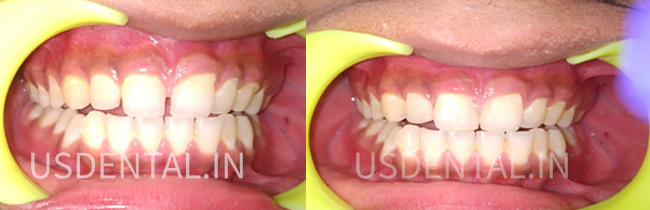 How to fix a chipped tooth?