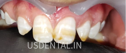 How to fix a chipped tooth?