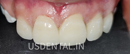 How to fix a chipped tooth?