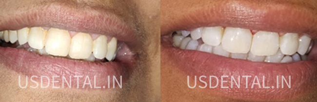 How to fix a chipped tooth?