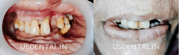 Replacing Missing Teeth?