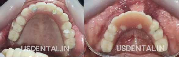 Replacing Missing Teeth?