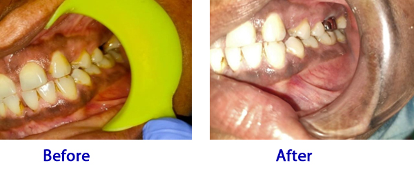 Replacing Missing Teeth?