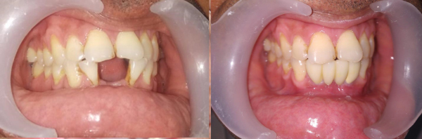 Replacing Missing Teeth?