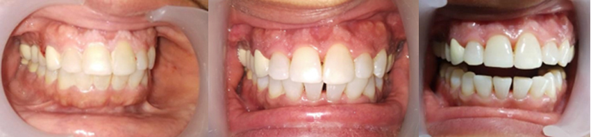 Replacing Missing Teeth?