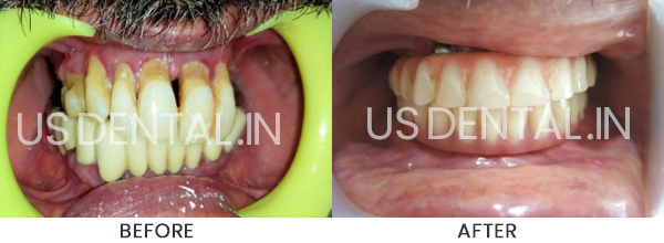 Dental Implants to Replace Missing Back Teeth