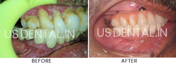 Dental Implants to Replace Missing Back Teeth