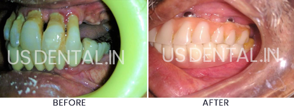 Dental Implants to Replace Missing Back Teeth