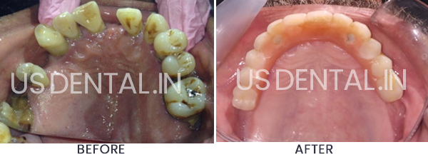 Dental Implants to Replace Missing Back Teeth