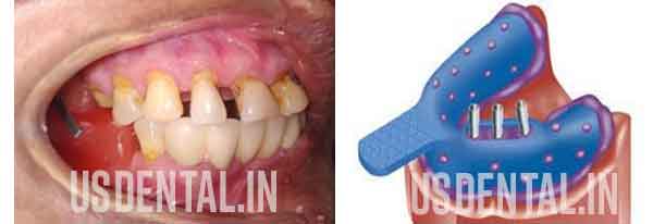 Dental Implants 
