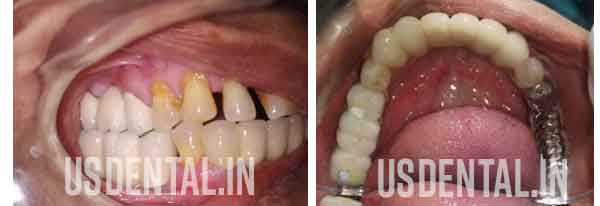 Dental Implants 