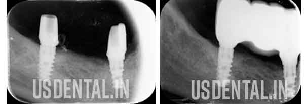 Dental Implants 