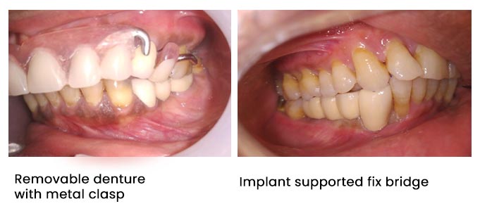 Dental Implants 